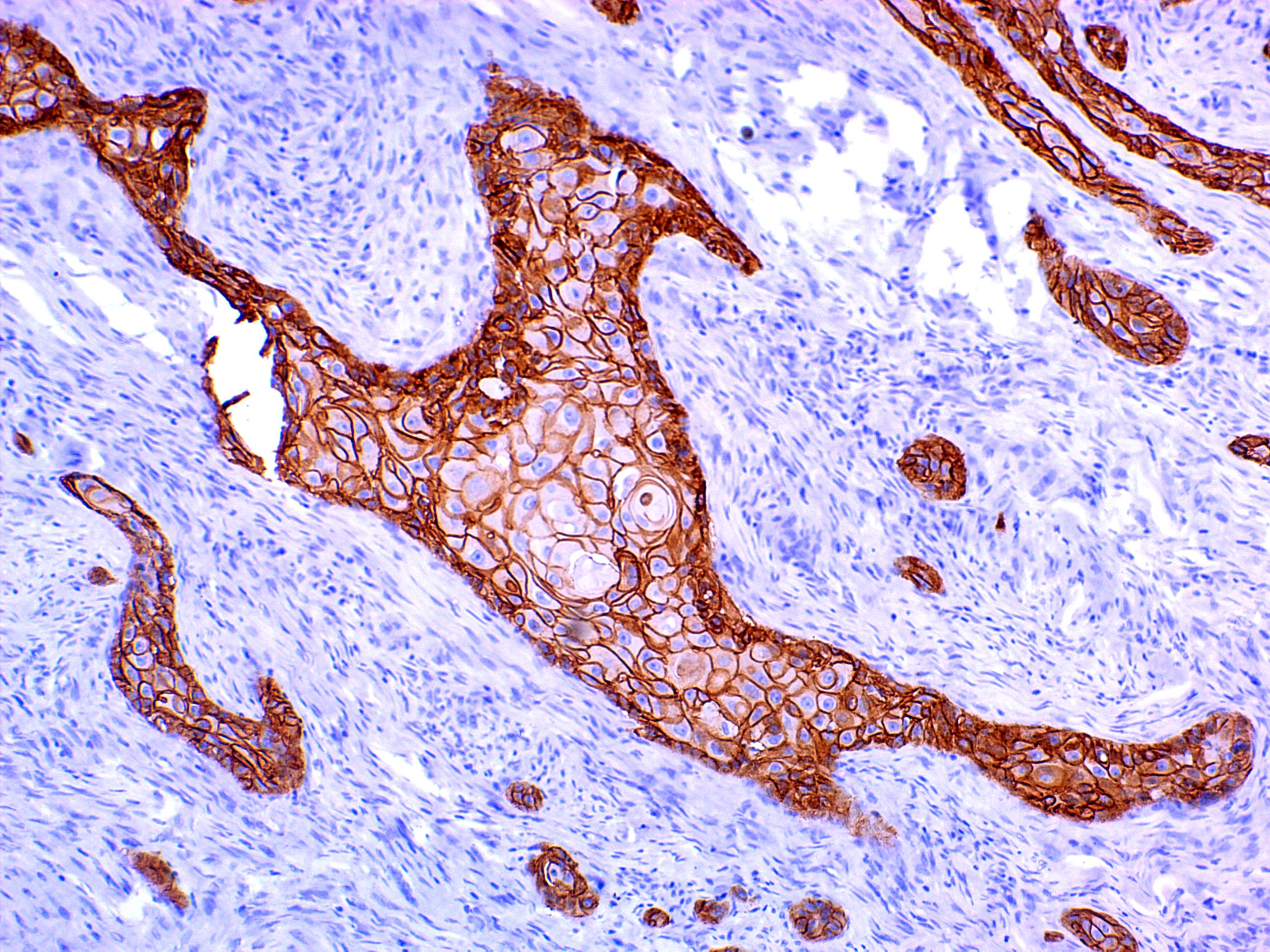 Stage I/II study of oral metronomic methotrexate with celecoxib and erlotinib as palliative chemotherapy in oral cancer patients