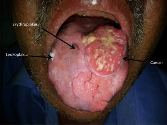 Oral cancers